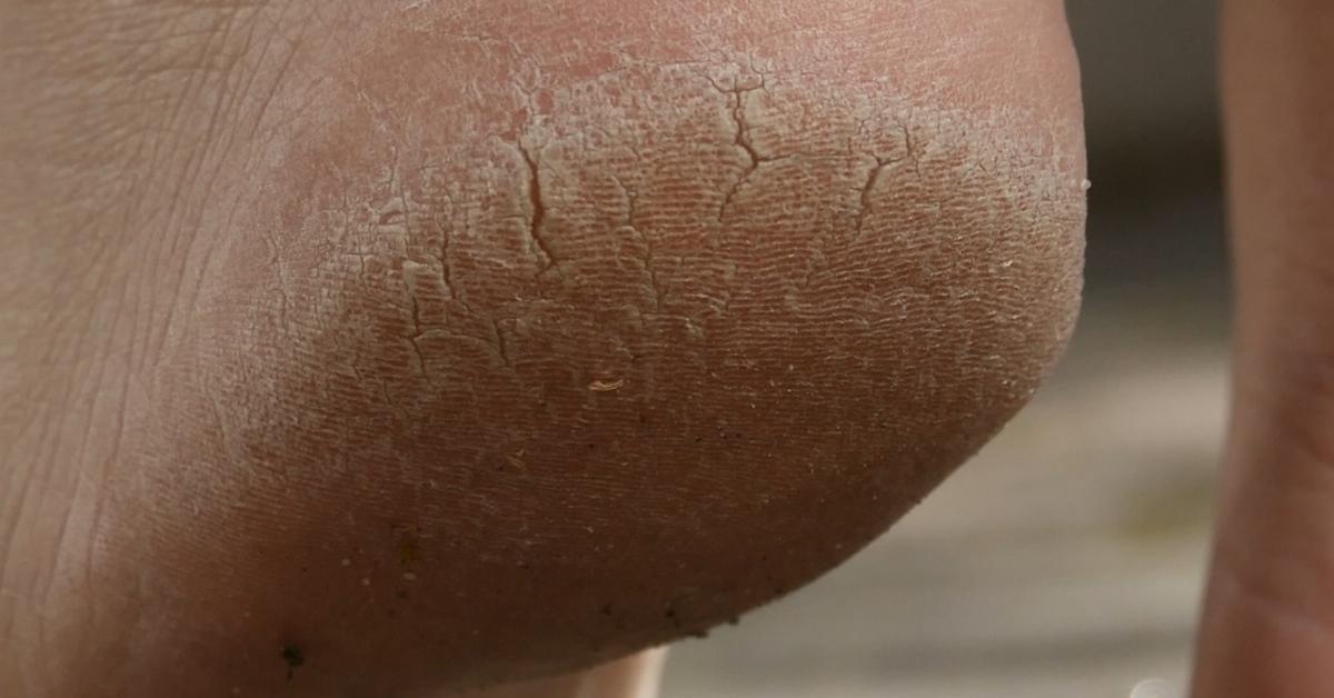 Грубая кожа на ступнях причиняет неудобства и выглядит неэстетично