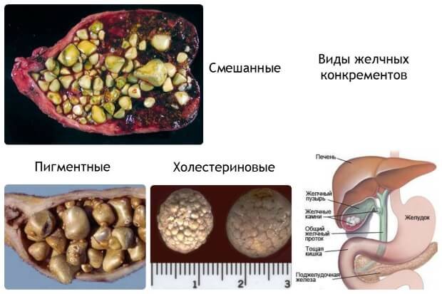 Виды конкрементов