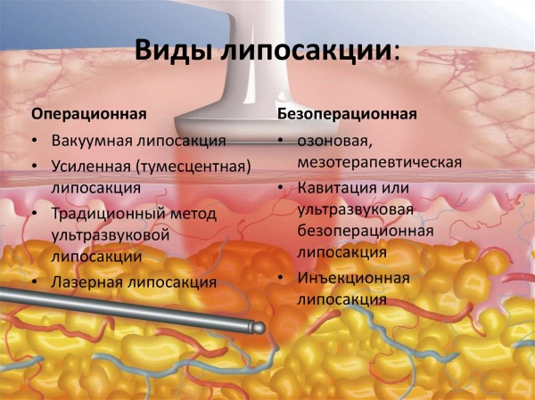 Как избавиться от горба на шее у женщин и мужчин. Массаж, гимнастика, упражнения, операция