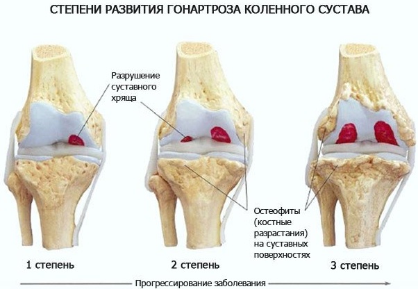 Гимнастика для коленных суставов при артрозе для пожилых