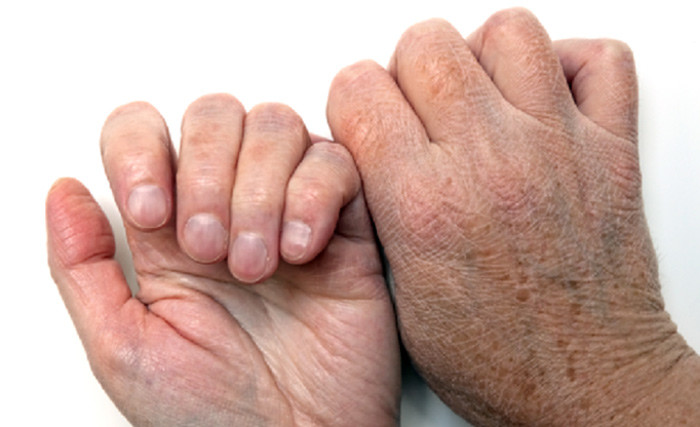 Сухость кожи у пожилых людей: причины возрастной патологии
