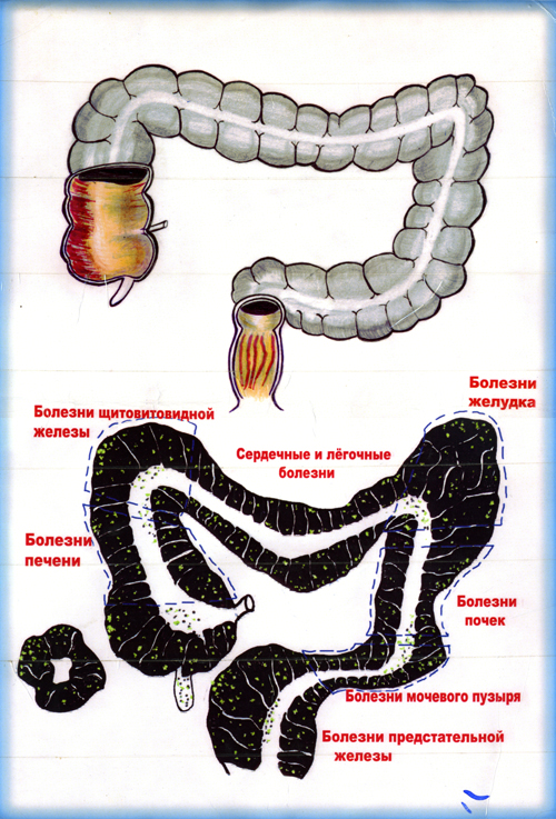 Очищение кишечника по методике М.В.Оганян