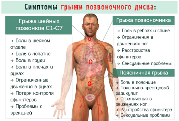 Симптомы грыжи позвоночного диска