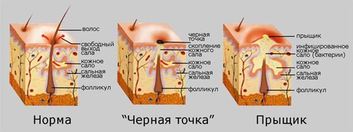 Прыщи и черные точки на лице