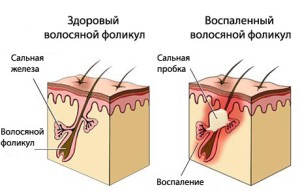 лечение жирных волос